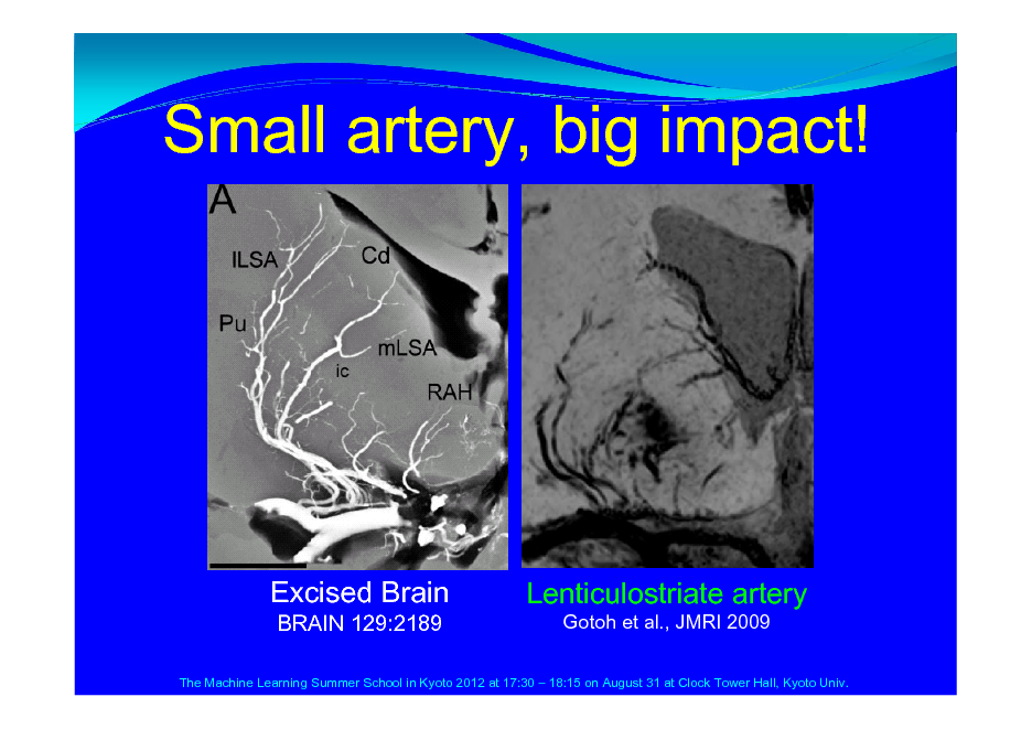 Slide: Small artery, big impact!

Excised Brain
BRAIN 129:2189

Lenticulostriate artery
Gotoh et al., JMRI 2009

The Machine Learning Summer School in Kyoto 2012 at 17:30  18:15 on August 31 at Clock Tower Hall, Kyoto Univ.

