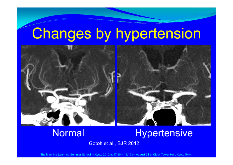 Slide: Changes by hypertension

Normal

Hypertensive
Gotoh et al., BJR 2012

The Machine Learning Summer School in Kyoto 2012 at 17:30  18:15 on August 31 at Clock Tower Hall, Kyoto Univ.


