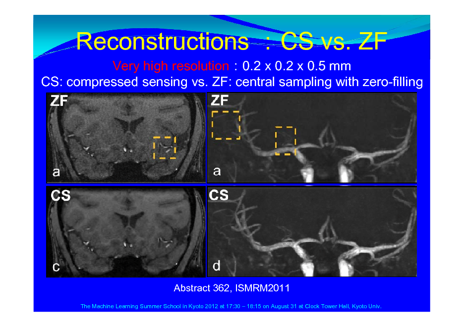 Slide: Reconstructions CS vs. ZF
Very high resolution0.2 x 0.2 x 0.5 mm CS: compressed sensing vs. ZF: central sampling with zero-filling

Abstract 362, ISMRM2011
The Machine Learning Summer School in Kyoto 2012 at 17:30  18:15 on August 31 at Clock Tower Hall, Kyoto Univ.

